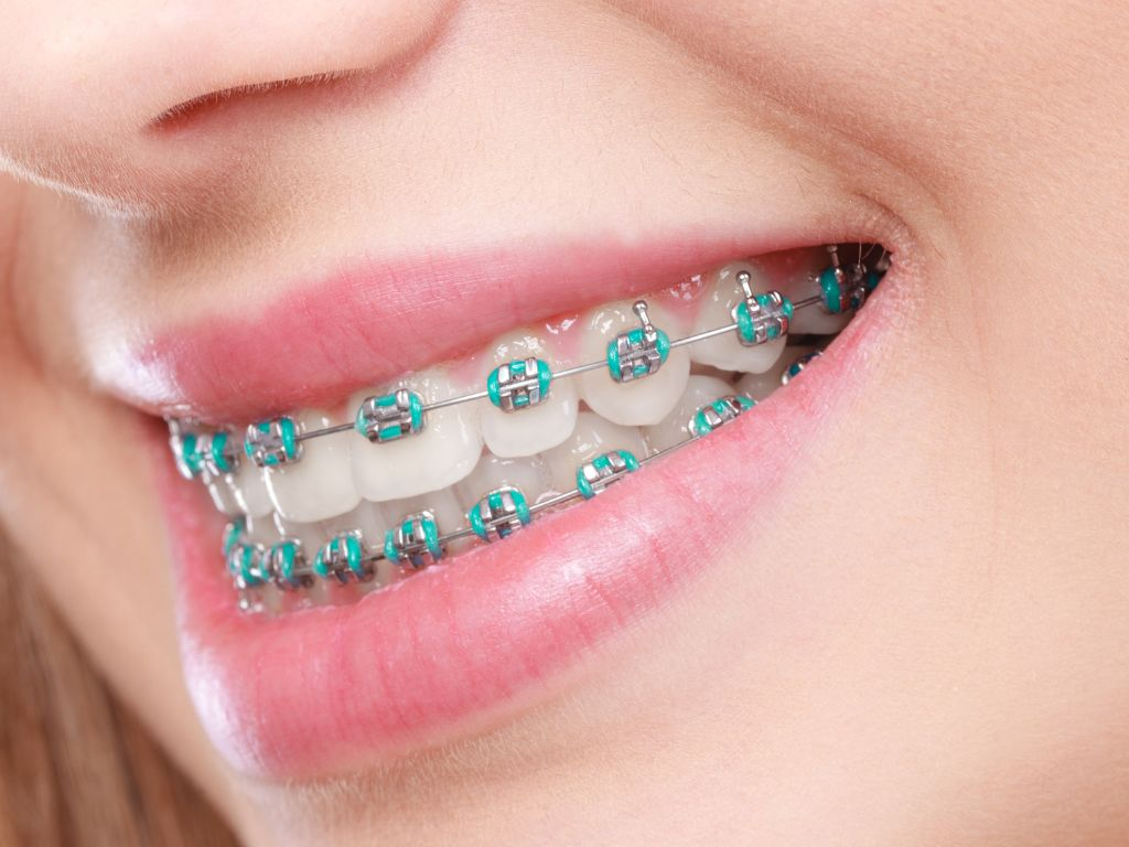 ăn uống khi niềng - hình 6