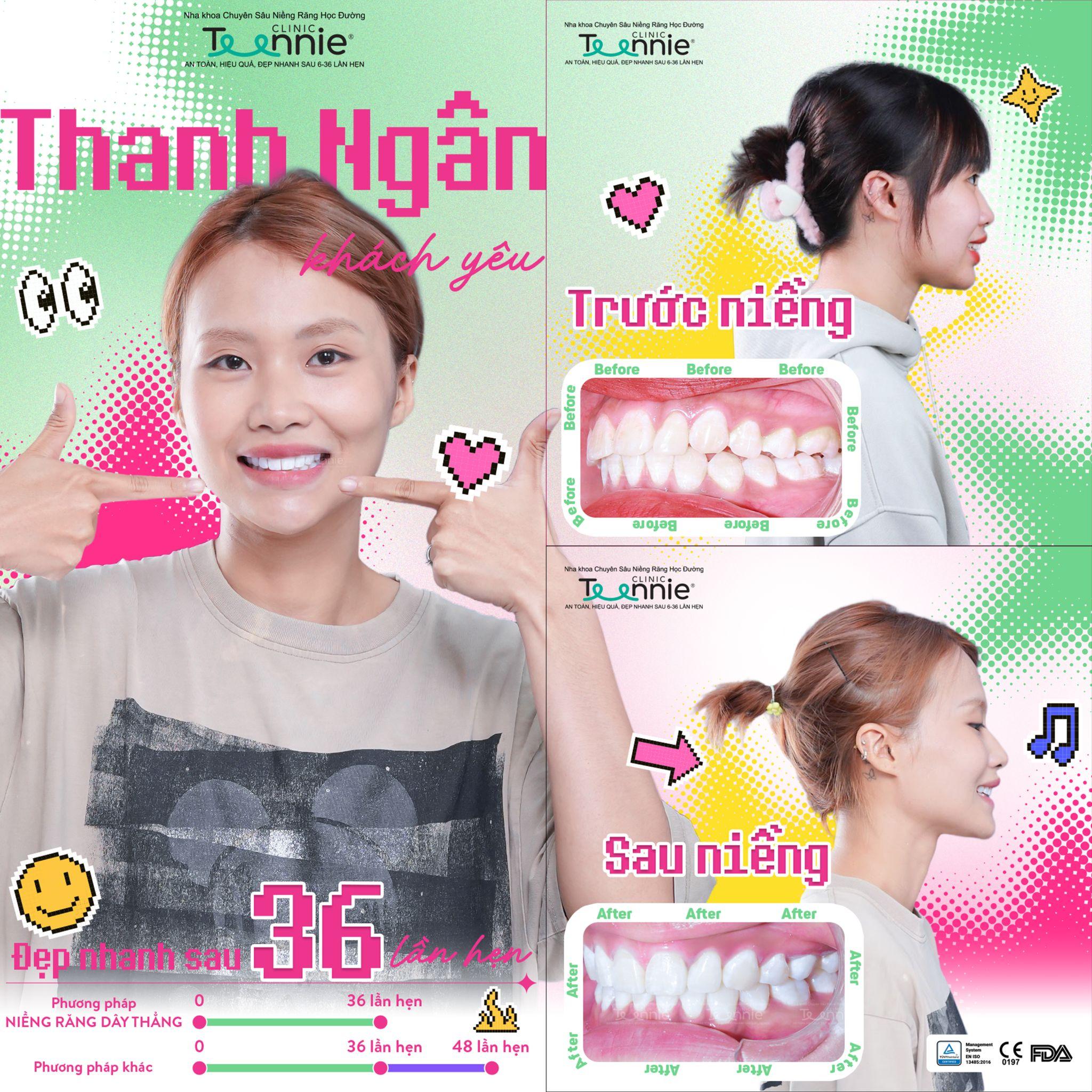 có nên niềng răng không