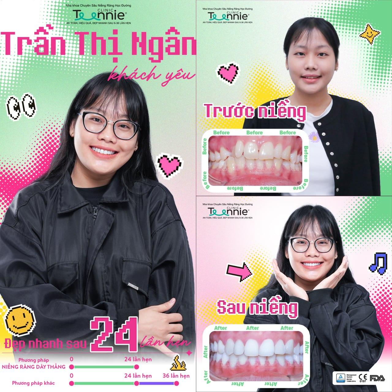 niềng răng cấp 1 - hình 2