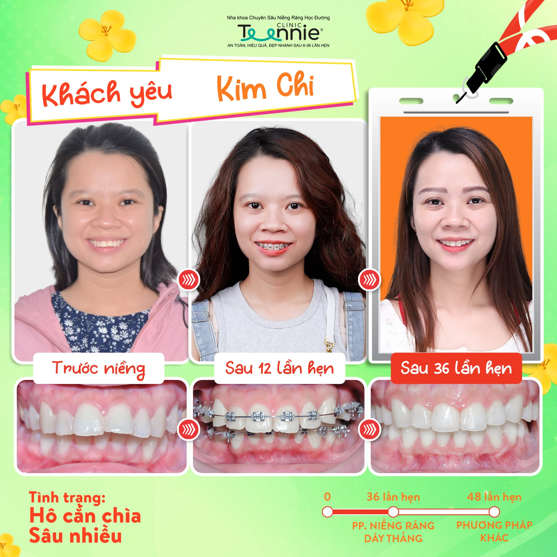 niềng răng cấp 1 - hình 4