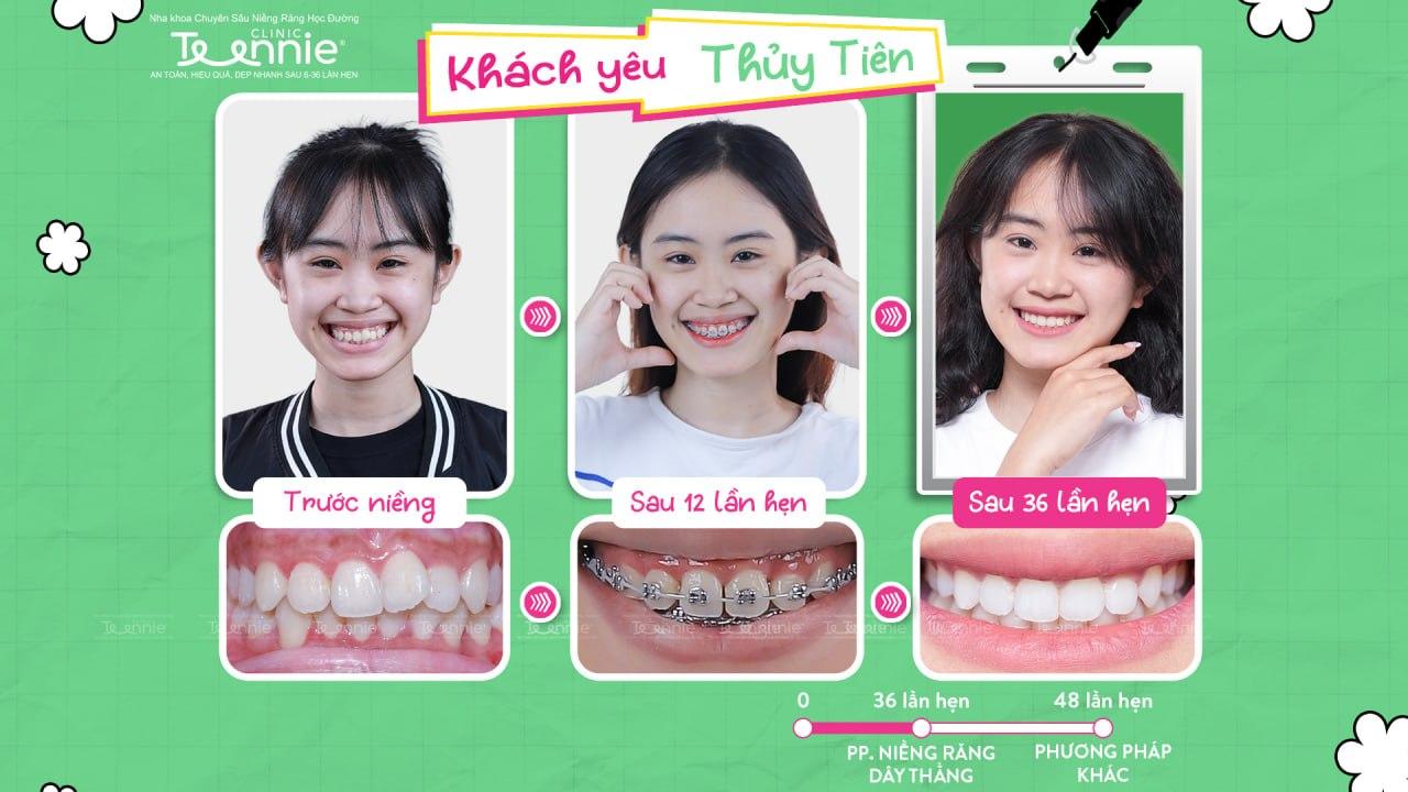 niềng răng cấp 1 - hình 5