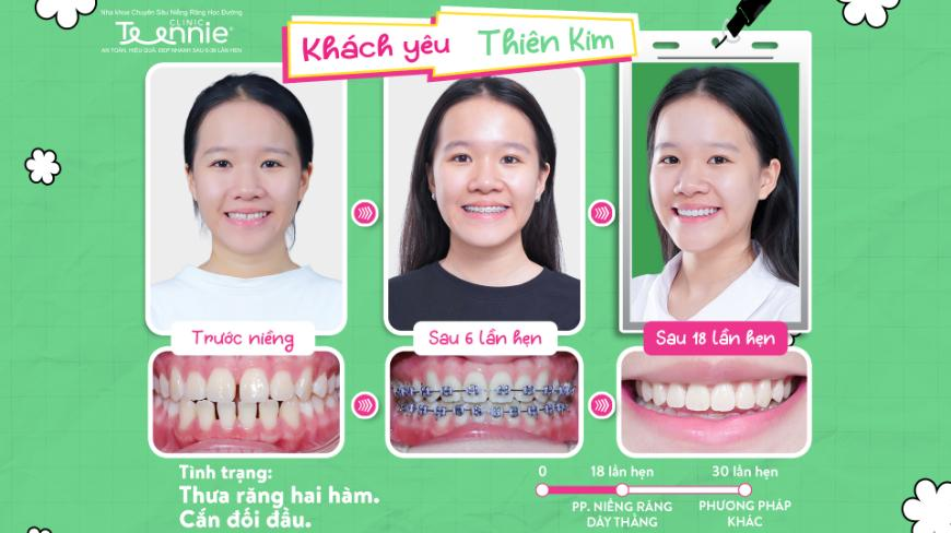 niềng răng tại nhà - hình 2