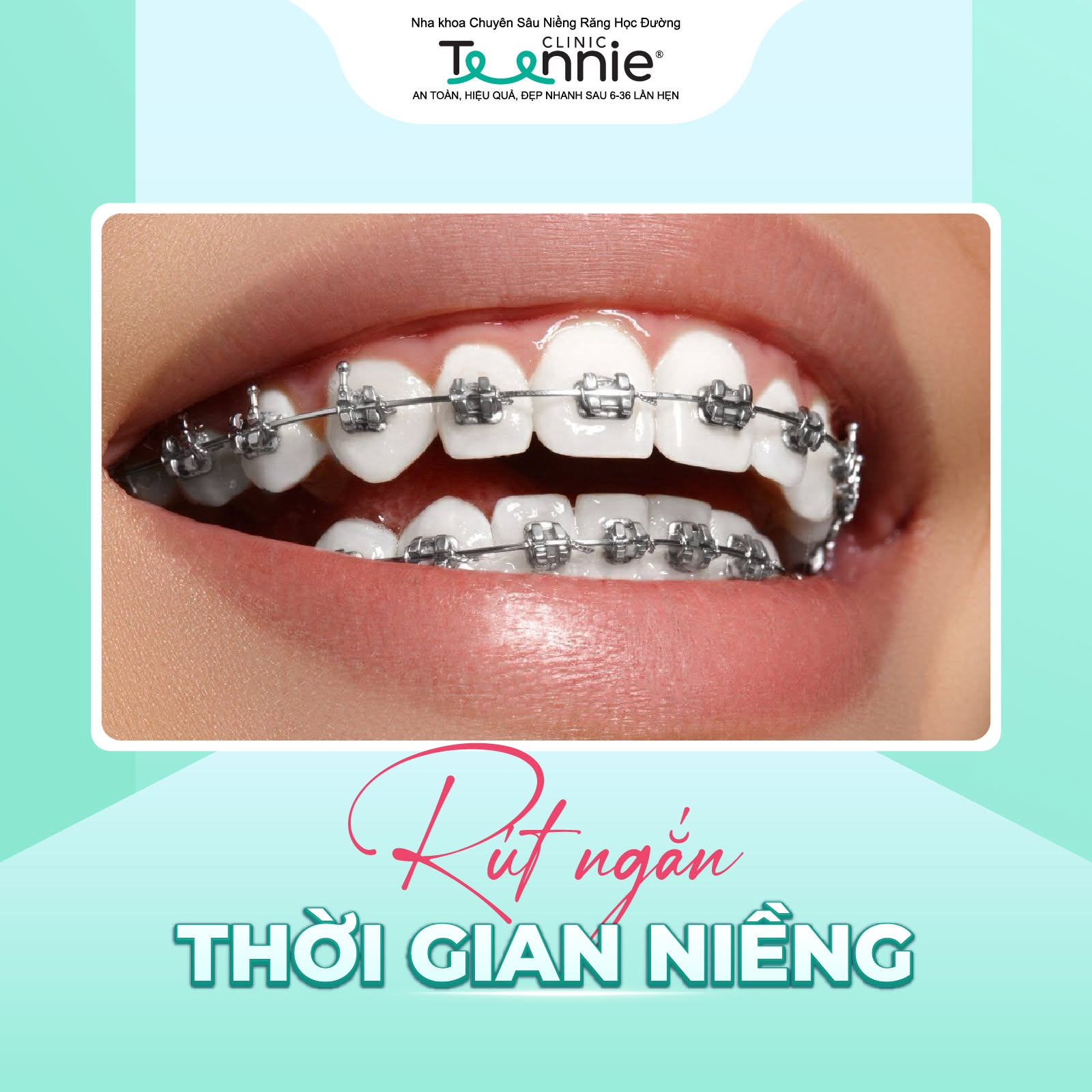 niềng răng tại nhà - hình 3