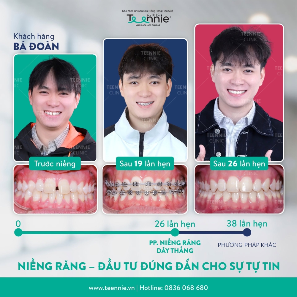 niềng thay đổi khuôn mặt