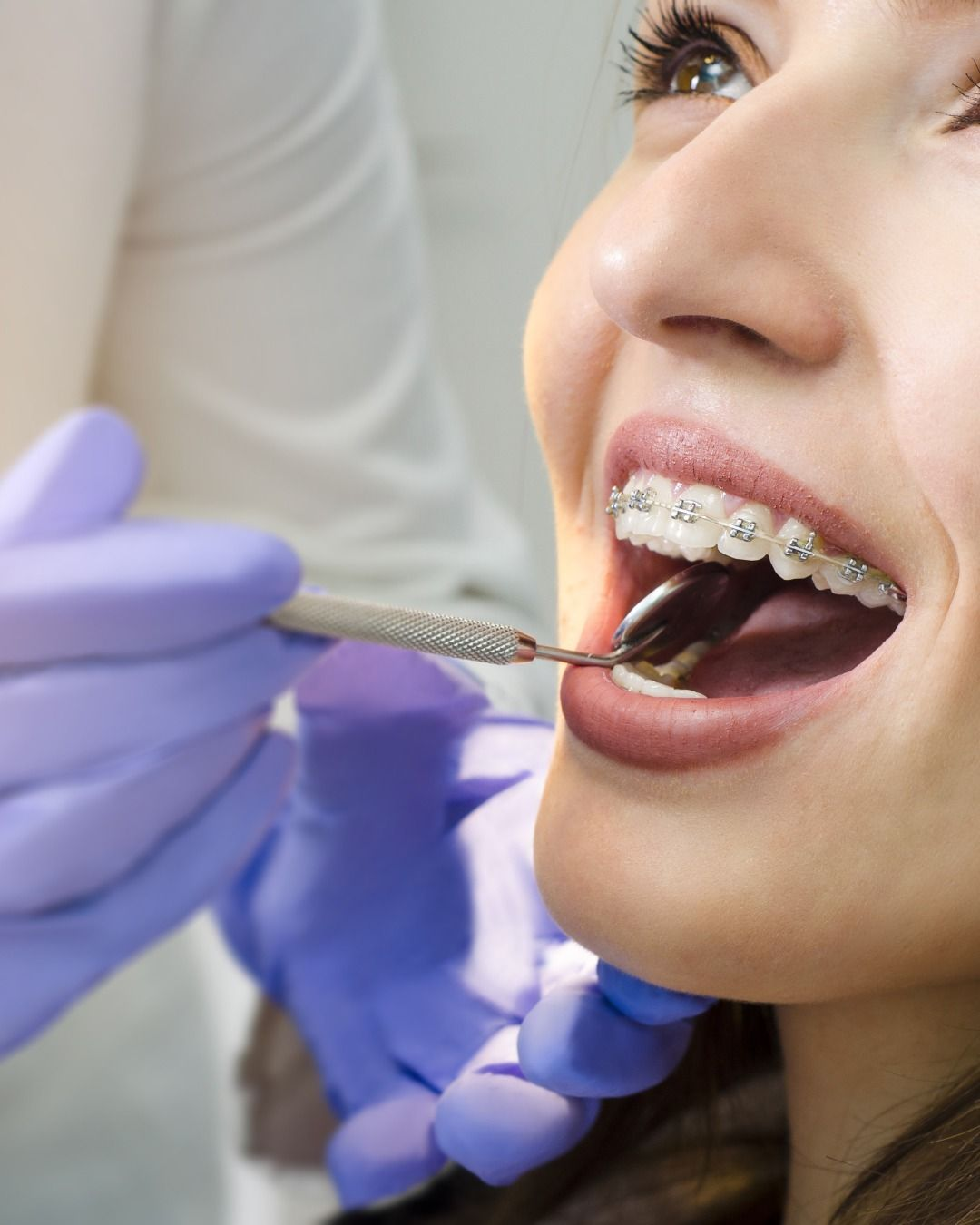 niềng răng trên 40 tuổi - hình 3