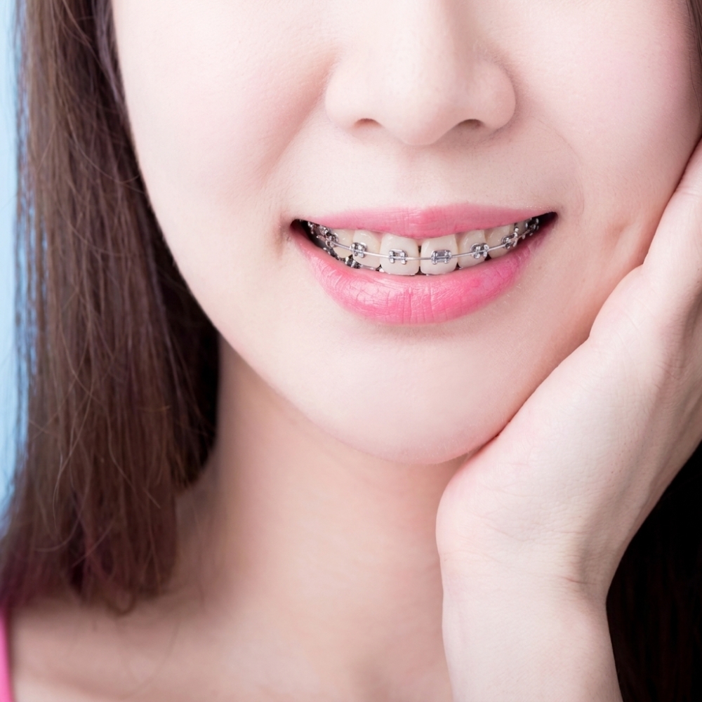 niềng răng tuổi 25 - hình 4