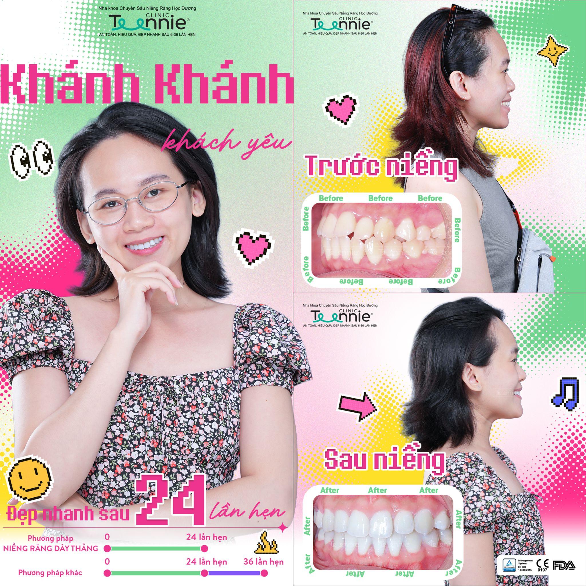 niềng răng vẩu xương - hình 2