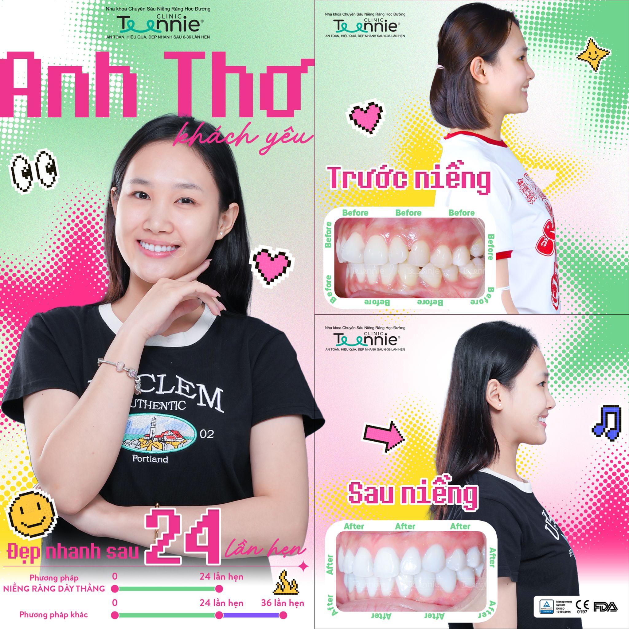 sau tháo niềng chăm sóc - hình 7