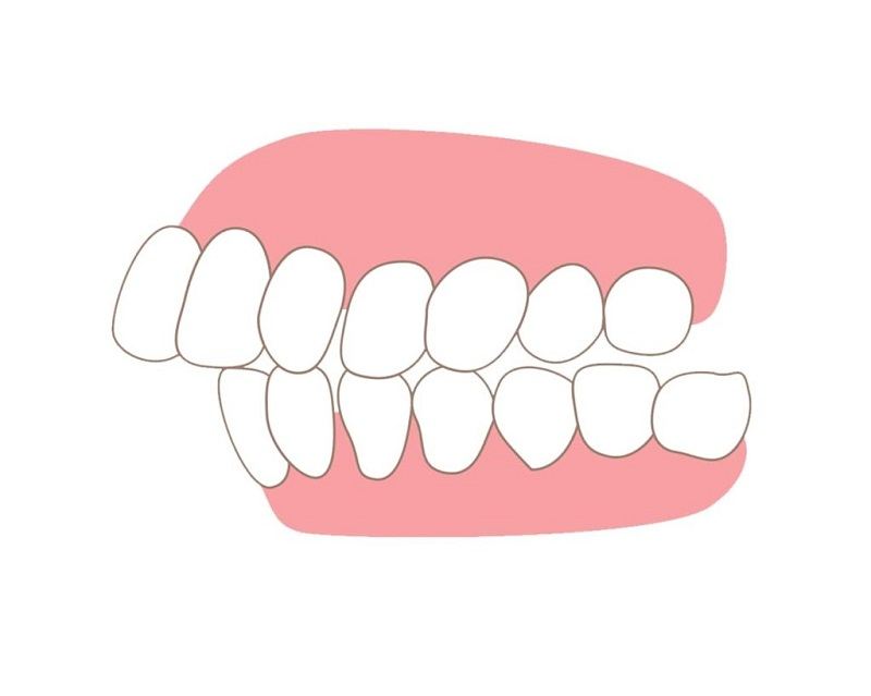 mắc cài kinh điển - hình 2