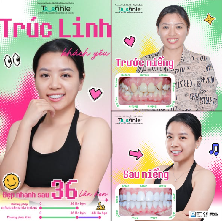 nghiến răng khi niềng - hình 5