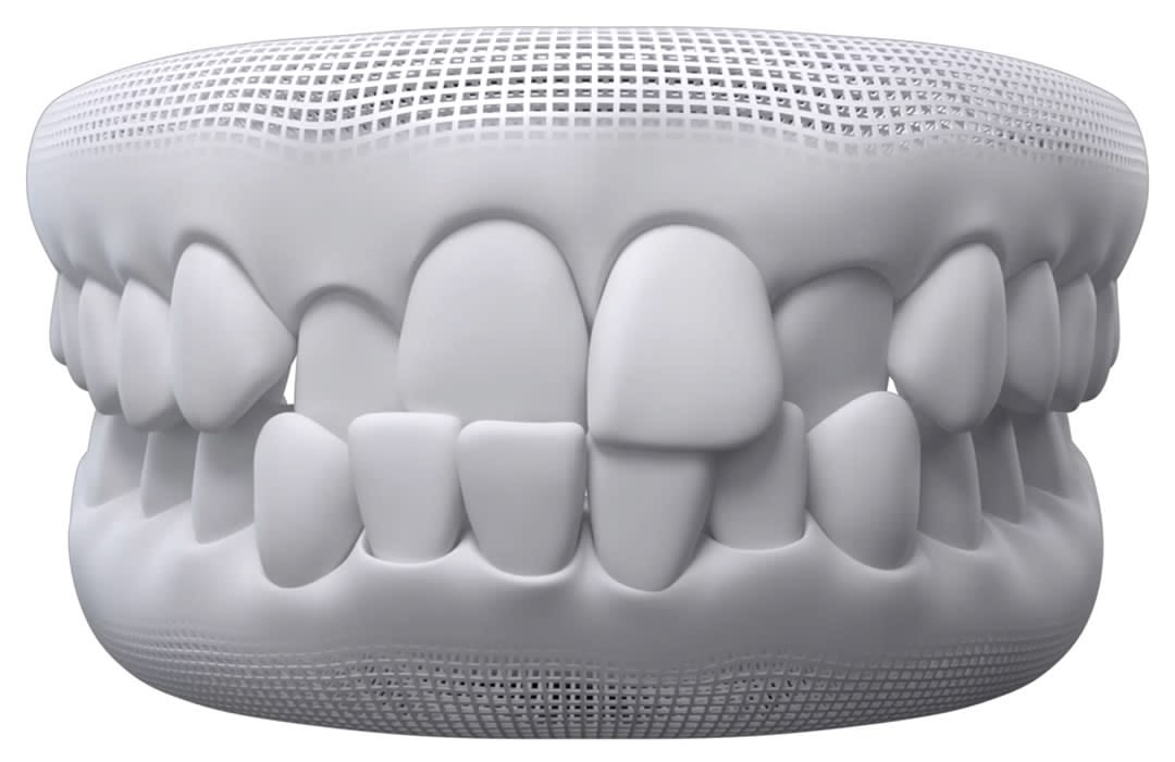 niềng răng cắn chéo - hình 2