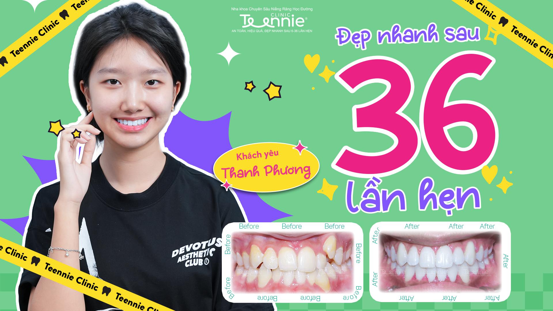niềng răng cắn chéo - hình 3