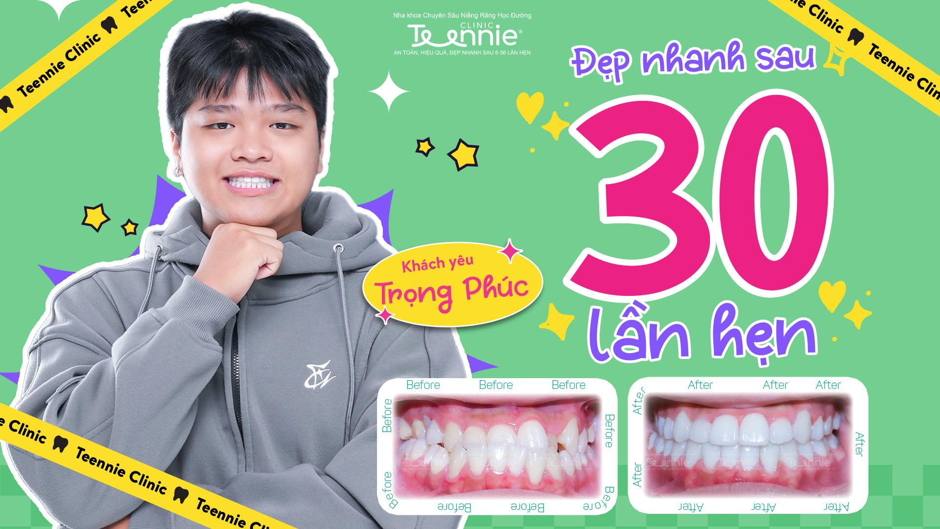 nieng rang can nguoc 1