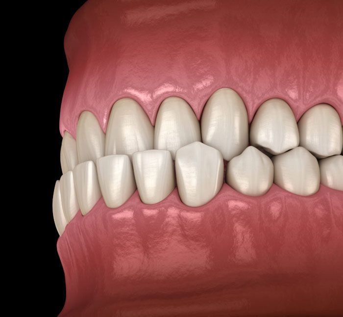 niềng răng cắn ngược - hình 2