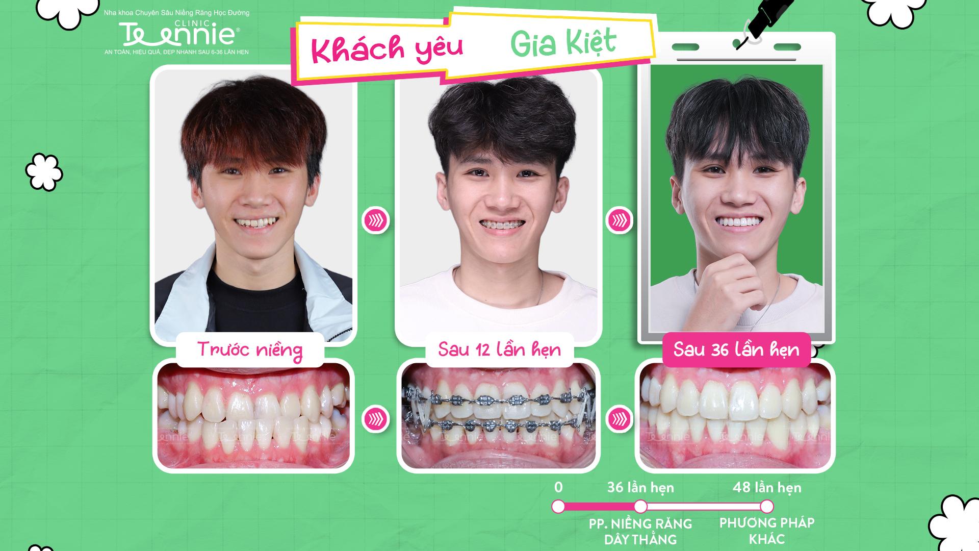 niềng răng cắn ngược - hình 6