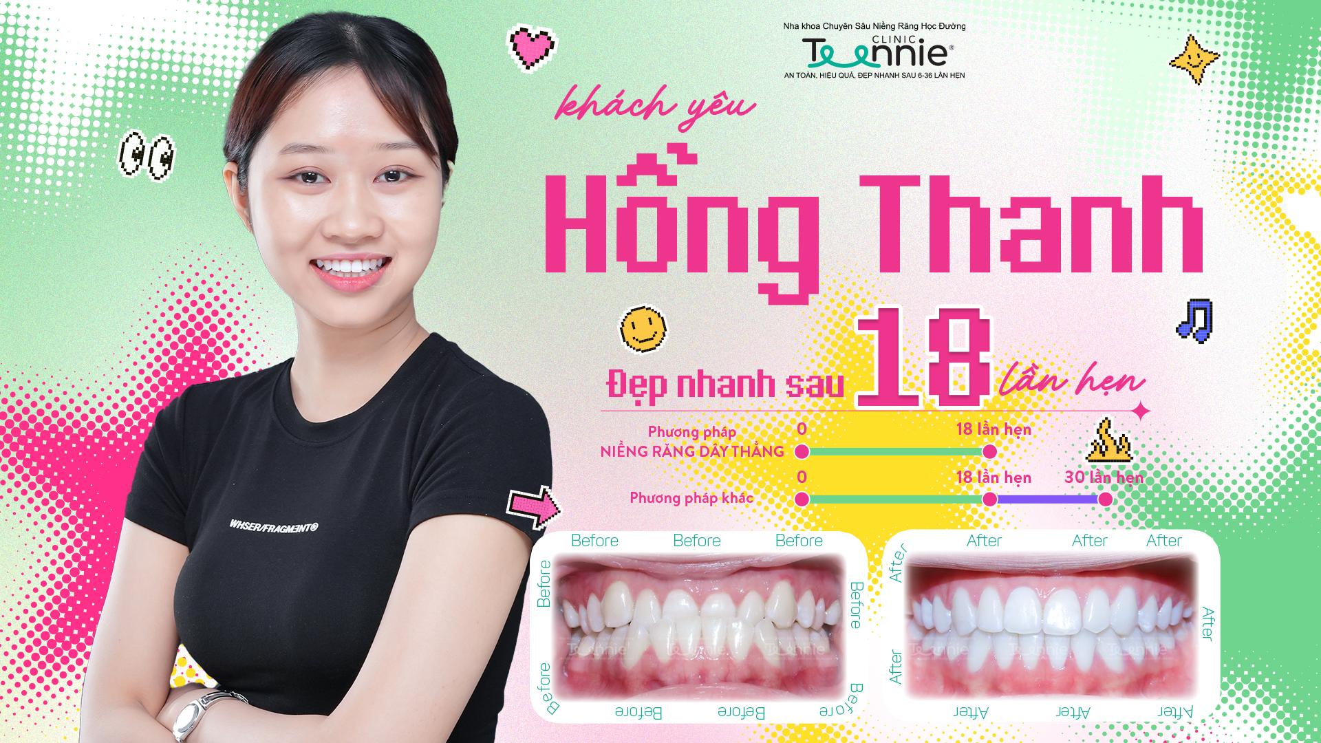 niềng răng cắn ngược - hình 7