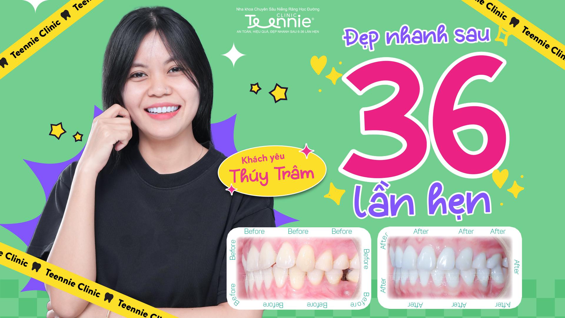 niềng răng đã bọc sứ - hình 4