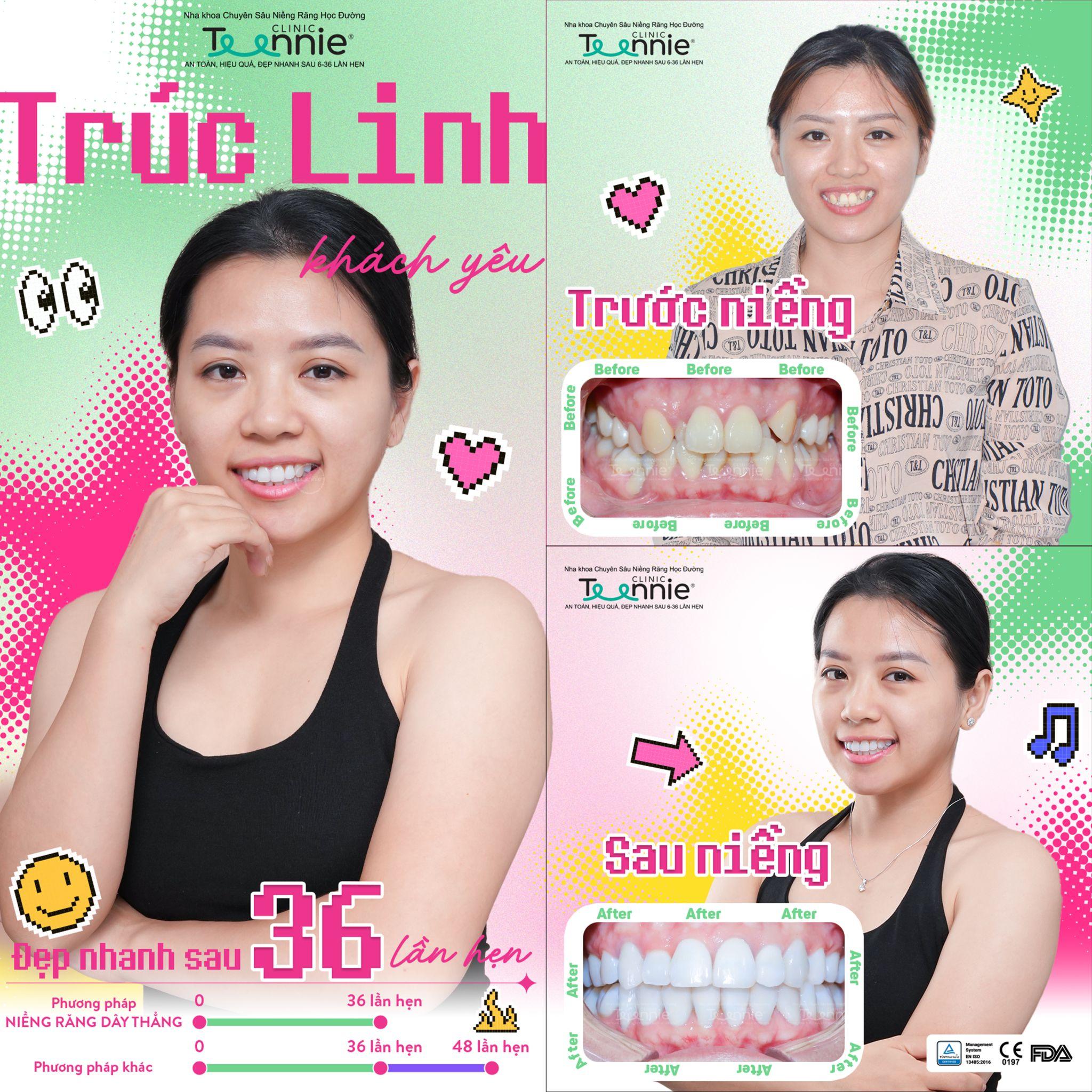 niềng răng đã bọc sứ - hình 5