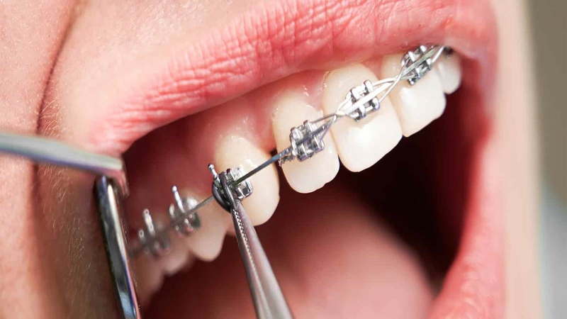 niềng răng vận động viên - hình 2