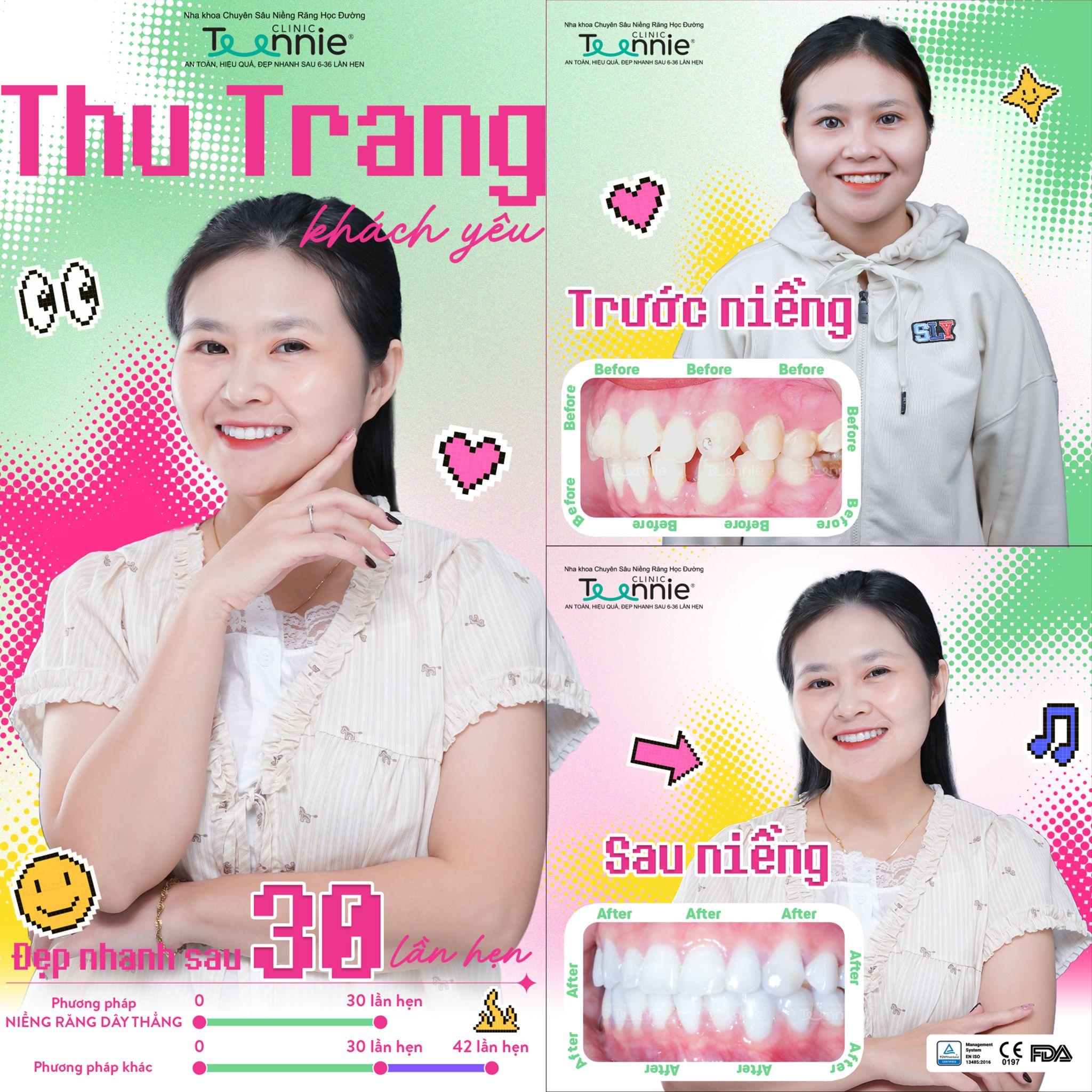 niềng răng vs bọc sứ - hình 5