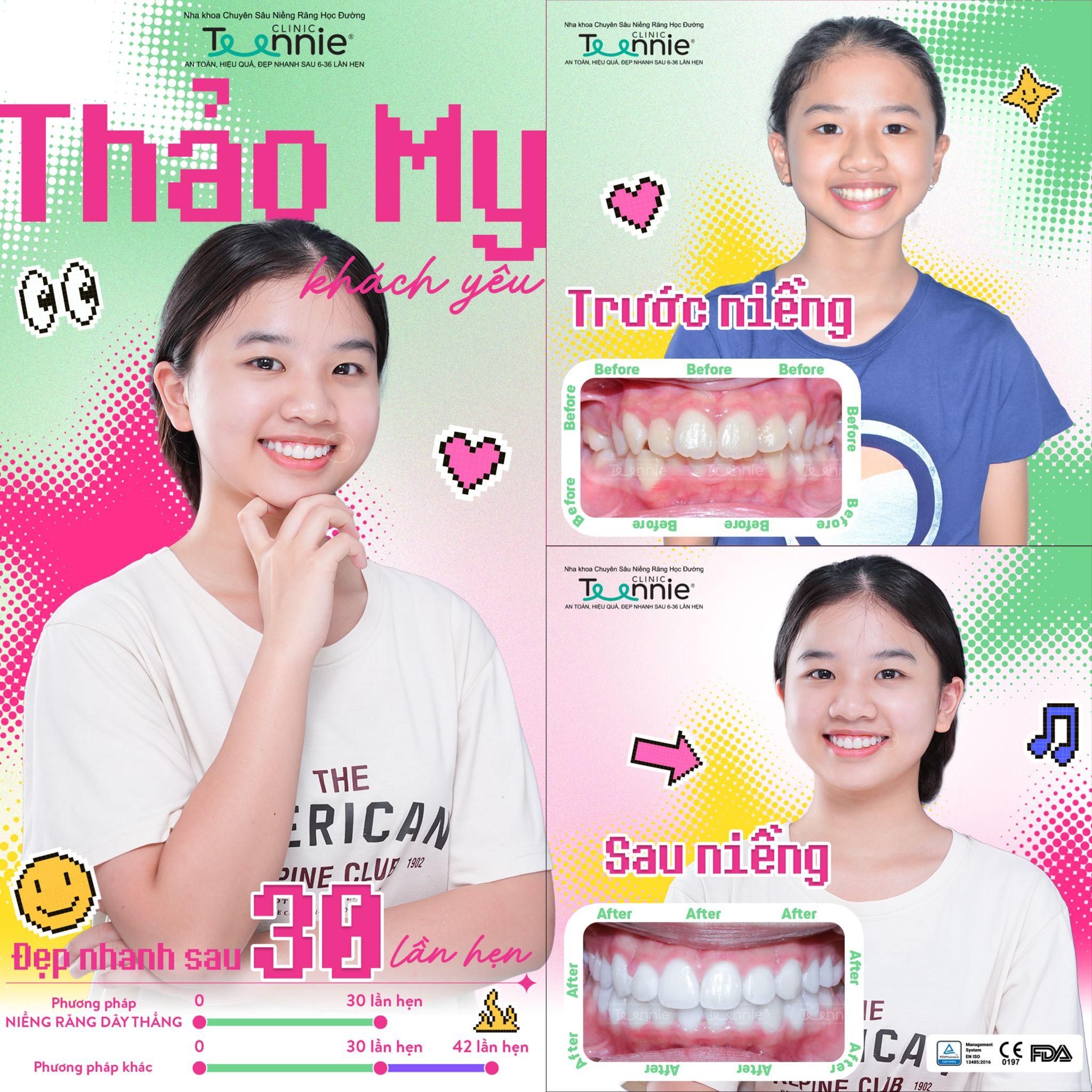 rơi thun mắc cài - hình 6
