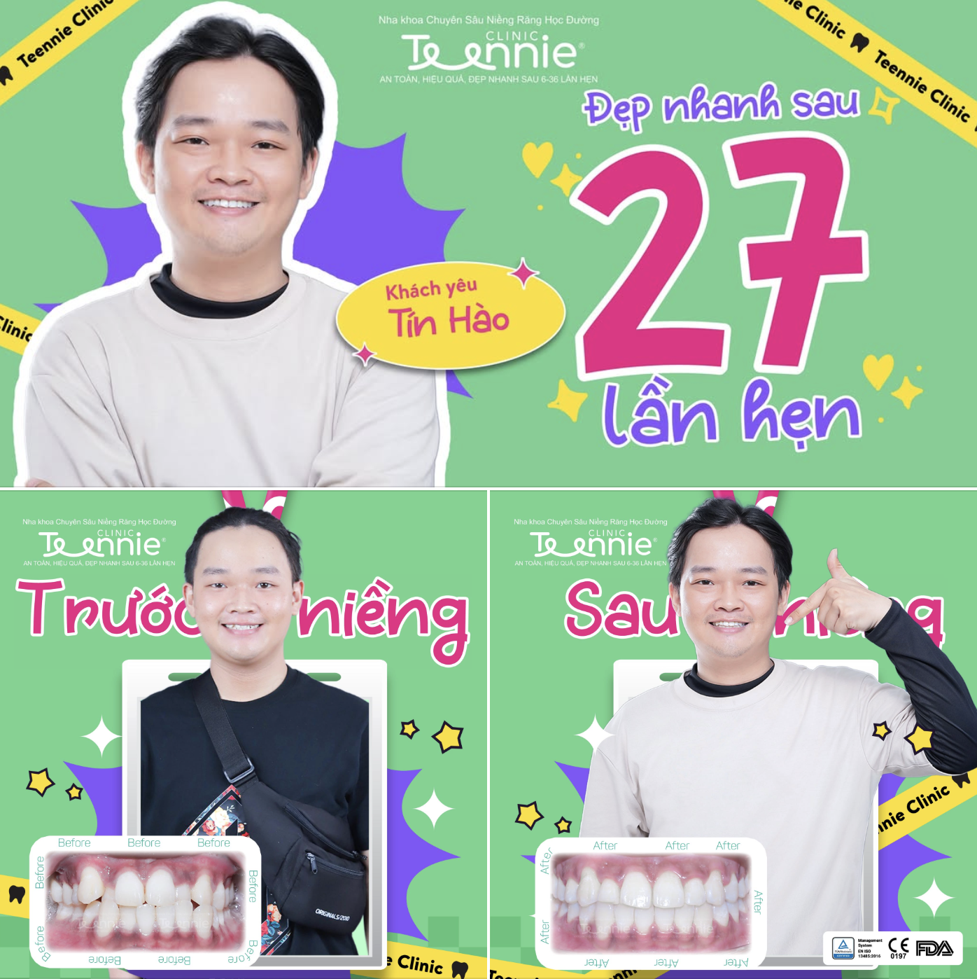 thâm nướu khi niềng - hình 2