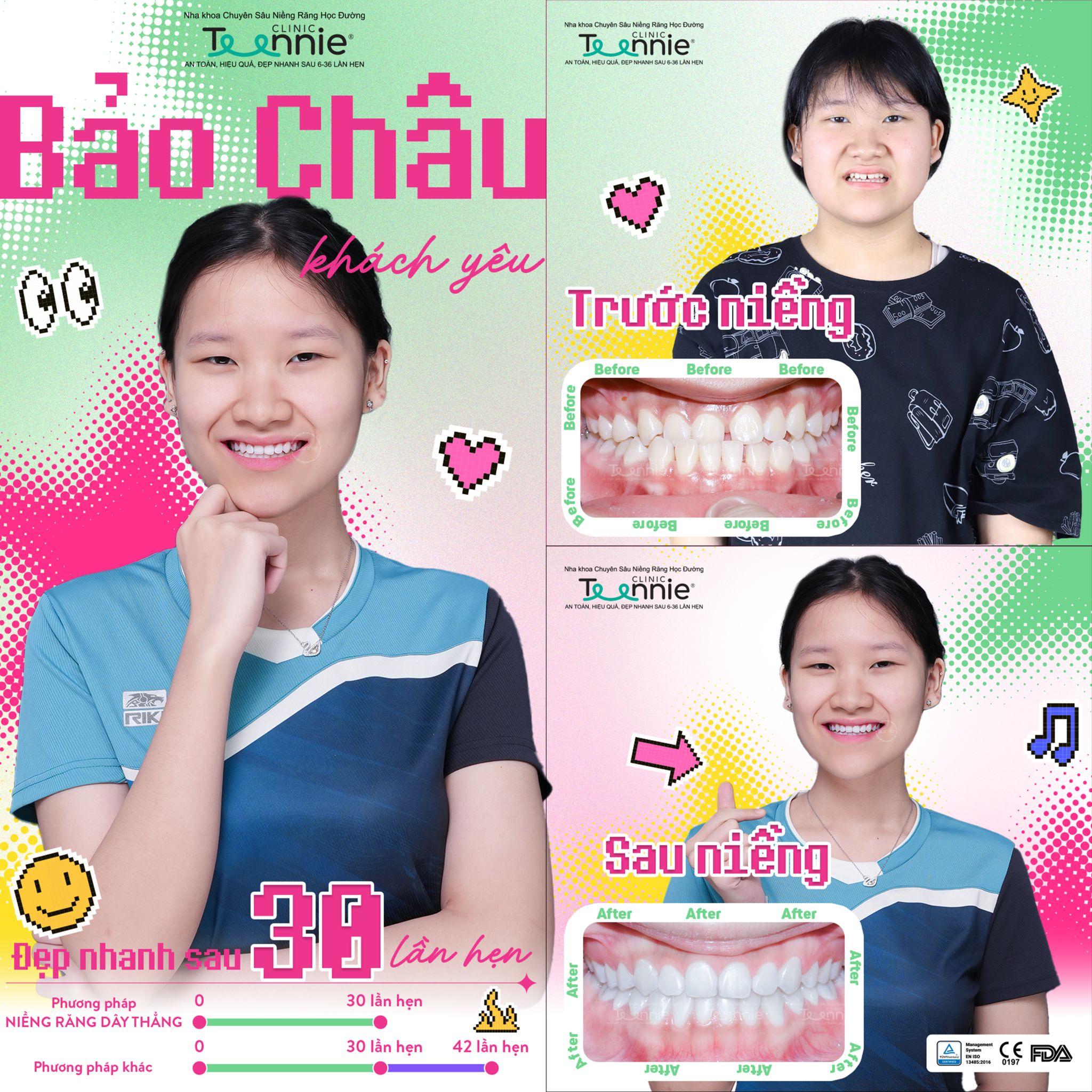 thâm nướu khi niềng - hình 5