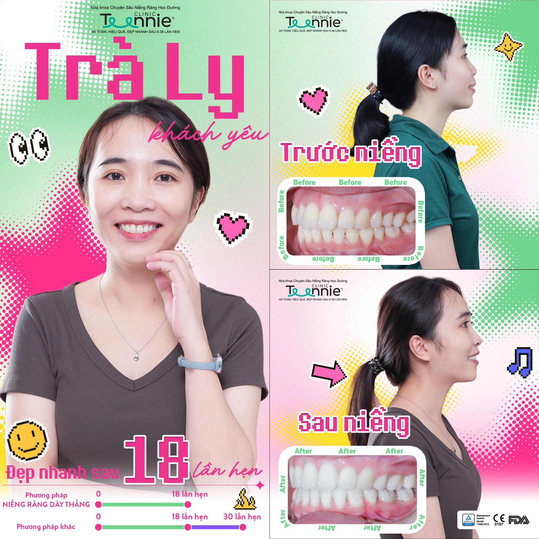 chi phí niềng răng m1 - hình 2