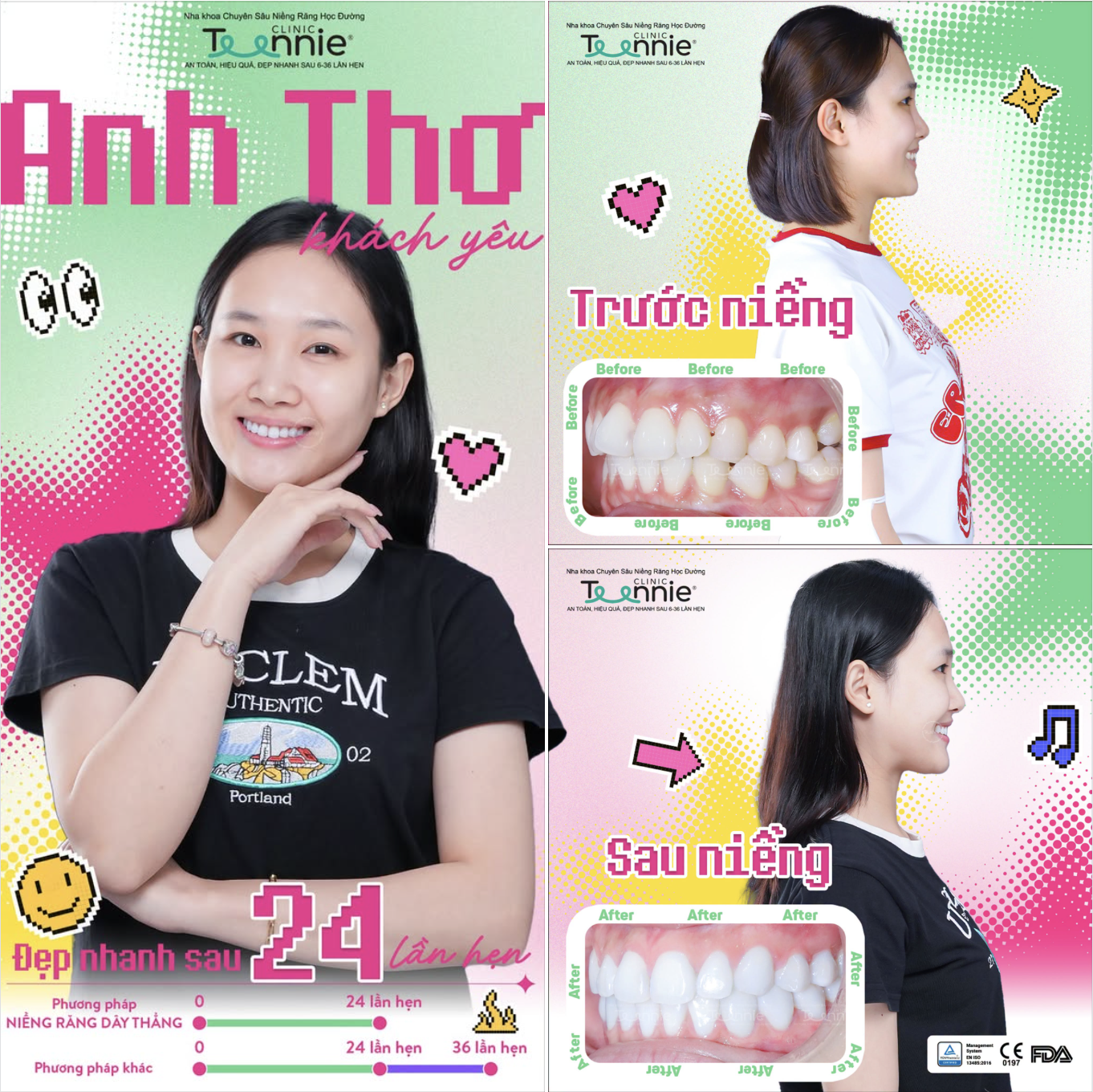 chi phí niềng răng m1 - hình 4