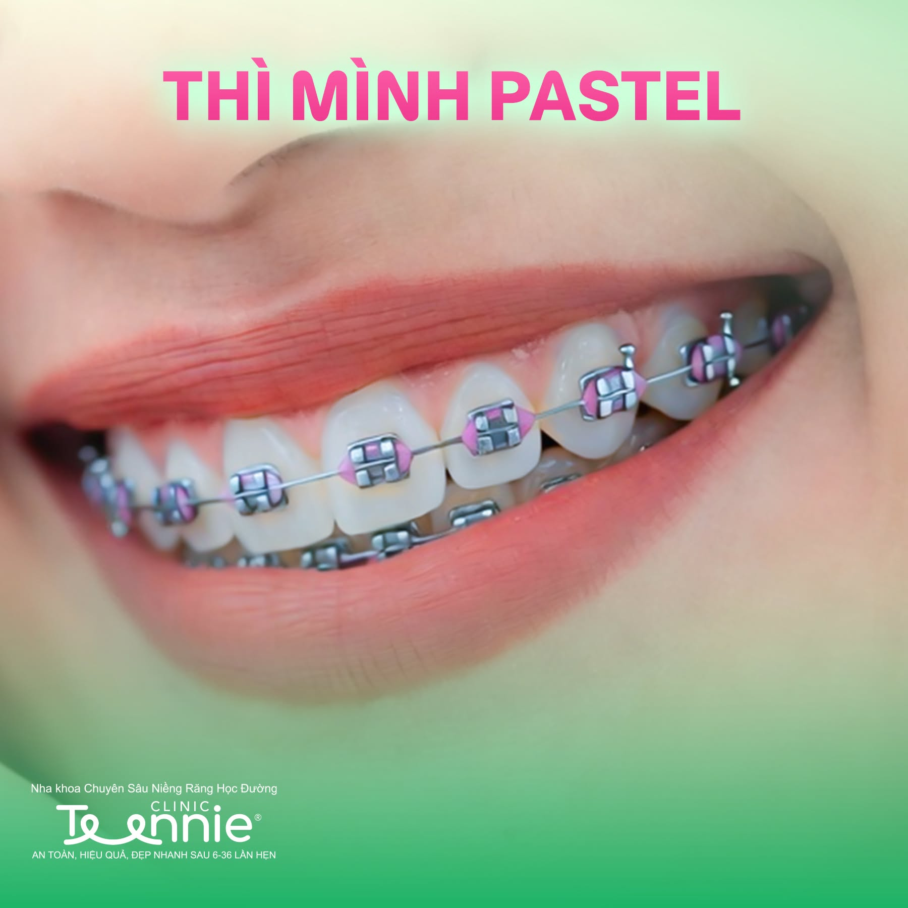 dây thun mắc cài - hình 6