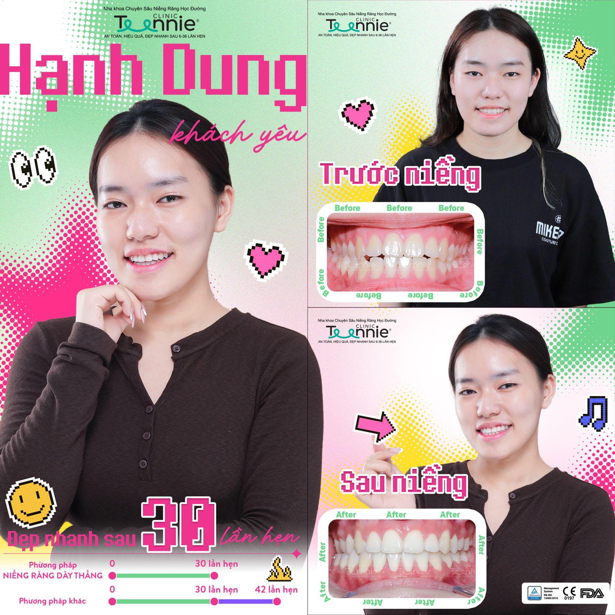 mắc cài kim loại - hình 3