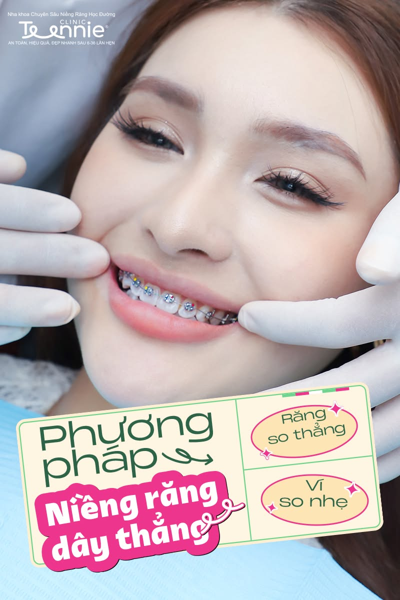 niềng dây thẳng - hình 2
