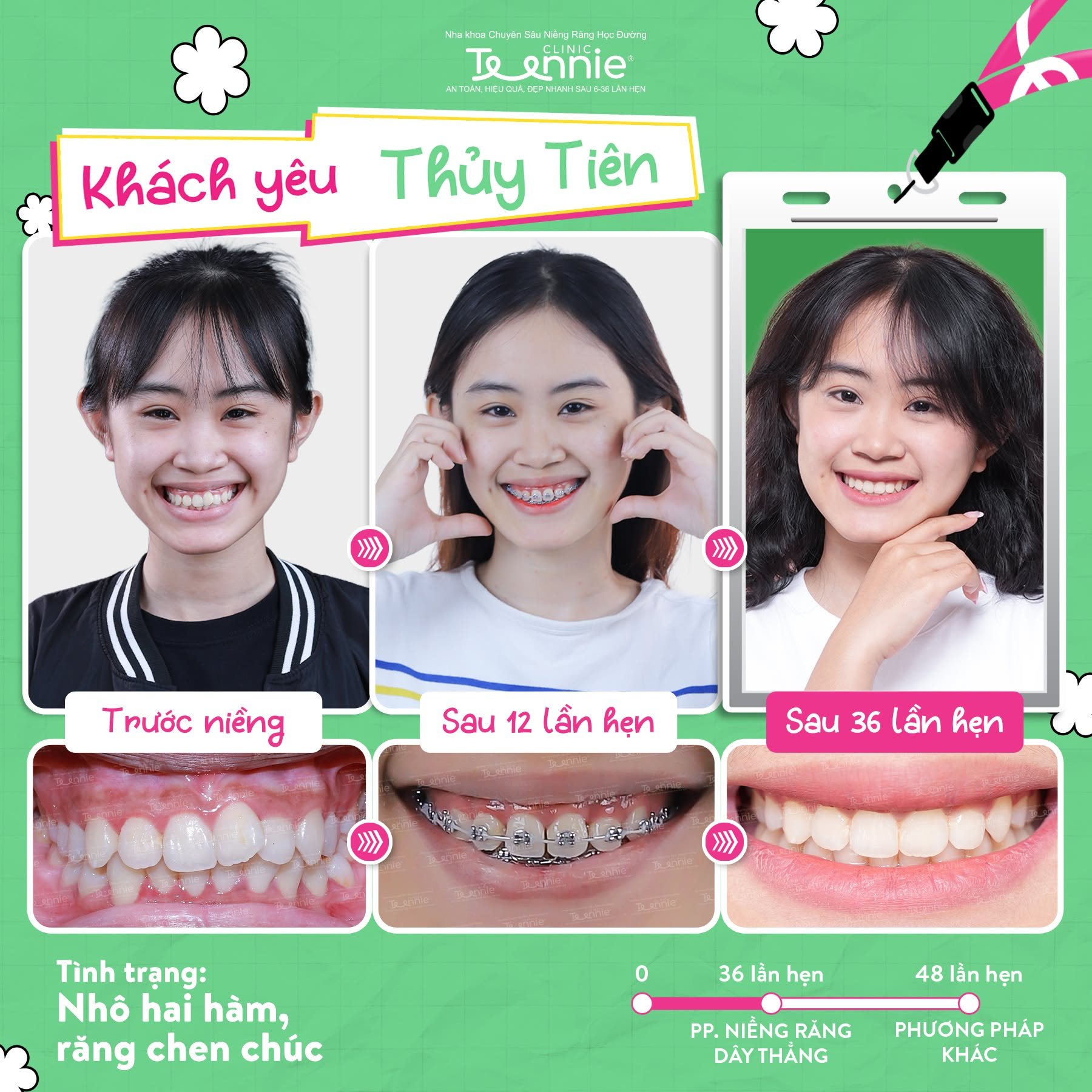 niềng răng bao lâu xong - hình 3