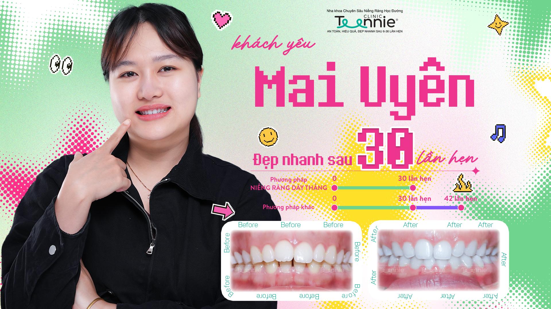 niềng răng bao lâu xong - hình 5
