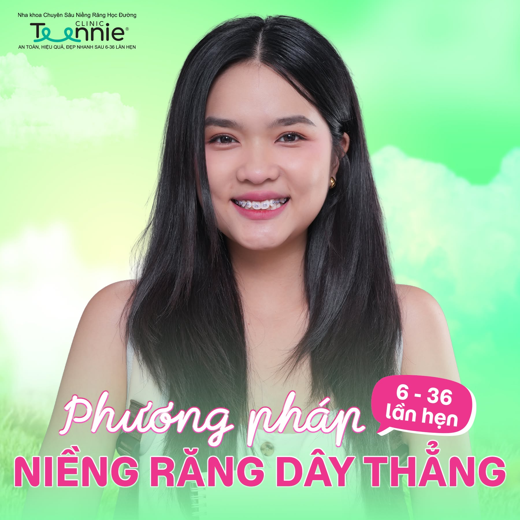 niềng răng bao lâu xong - hình 7