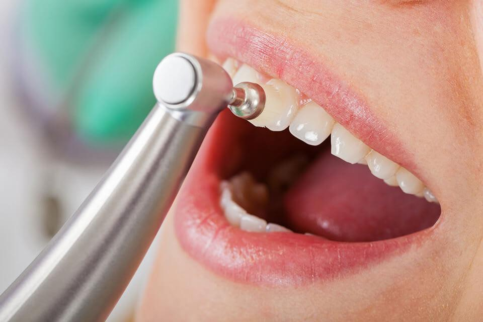 hàm duy trì sau niềng - hình 6