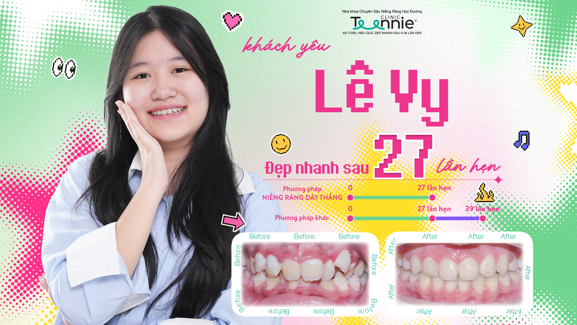 Niềng răng tuổi nào tốt nhất 2026