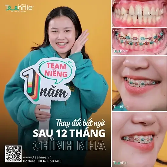 Khách hàng niềng răng trước và sau tại Teennie Clinic (1)