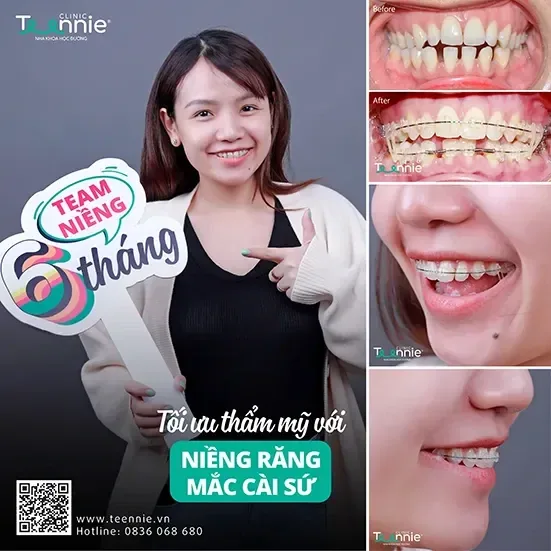 Khách hàng niềng răng trước và sau tại Teennie Clinic (2)