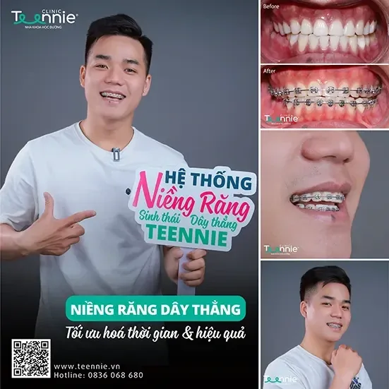Khách hàng niềng răng trước và sau tại Teennie Clinic (3)