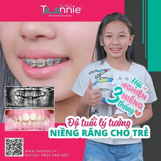 Khách hàng niềng răng trước và sau tại Teennie Clinic (4)