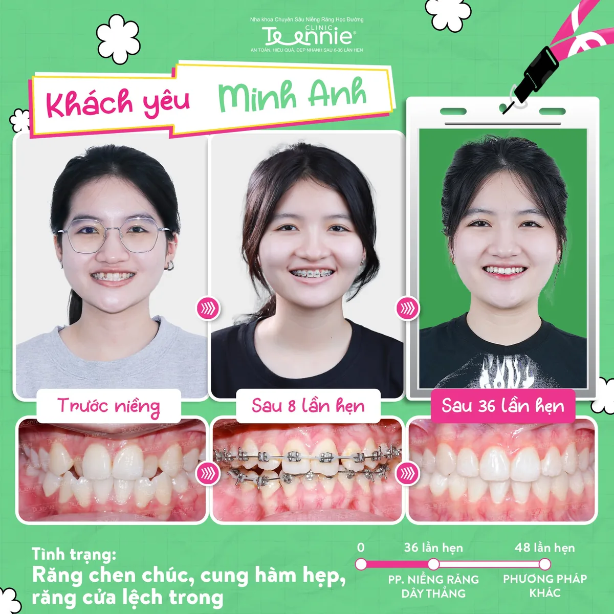 Khách hàng Minh Anh niềng răng trước và sau tại Teennie - răng chen chúc, cung hàm hẹp, răng cửa lệch trong, đẹp sau 36 lần hẹn