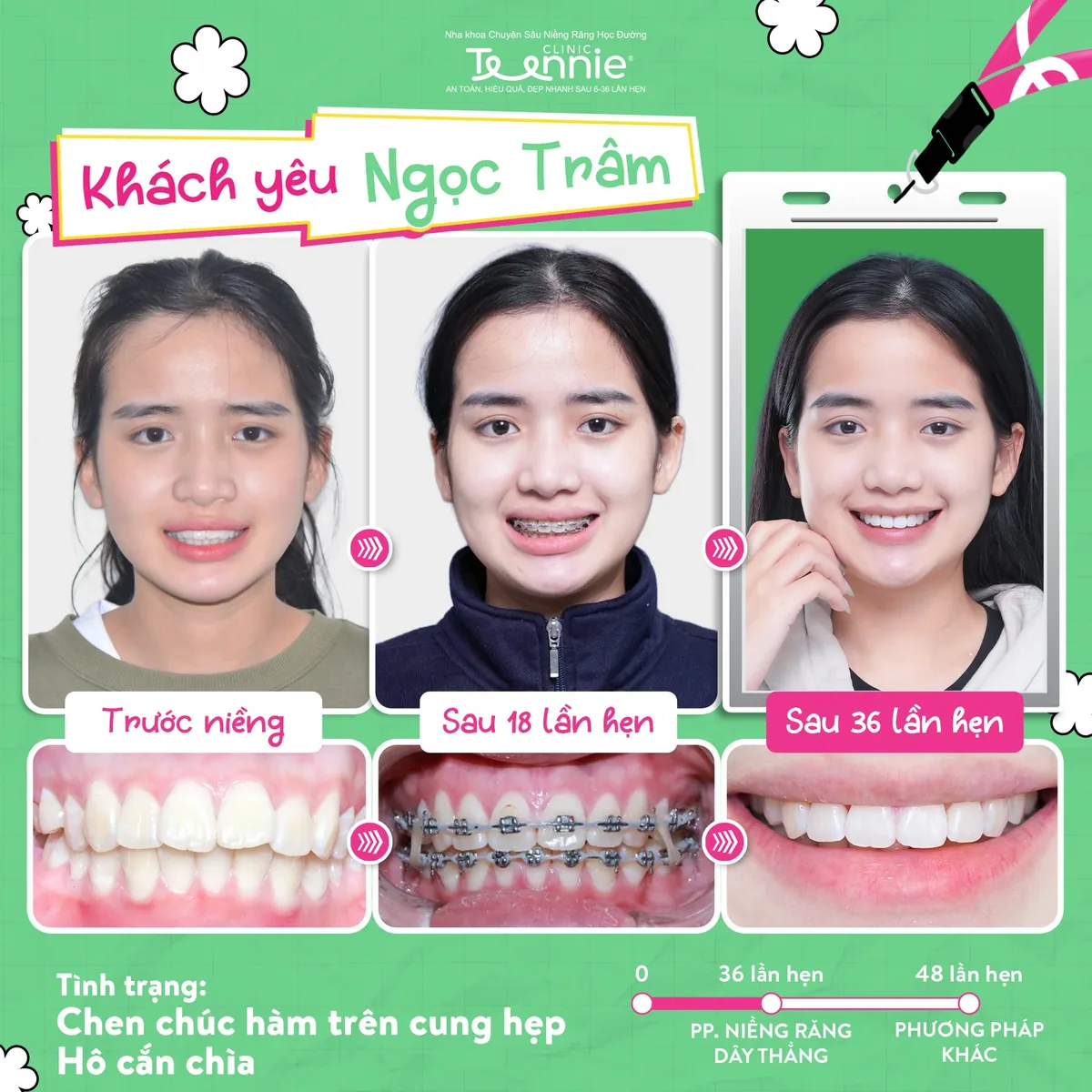 Khách hàng Ngọc Trâm niềng răng trước và sau tại Teennie - chen chúc hàm trên, cung hẹp, hô cắn chìa, đẹp sau 36 lần hẹn