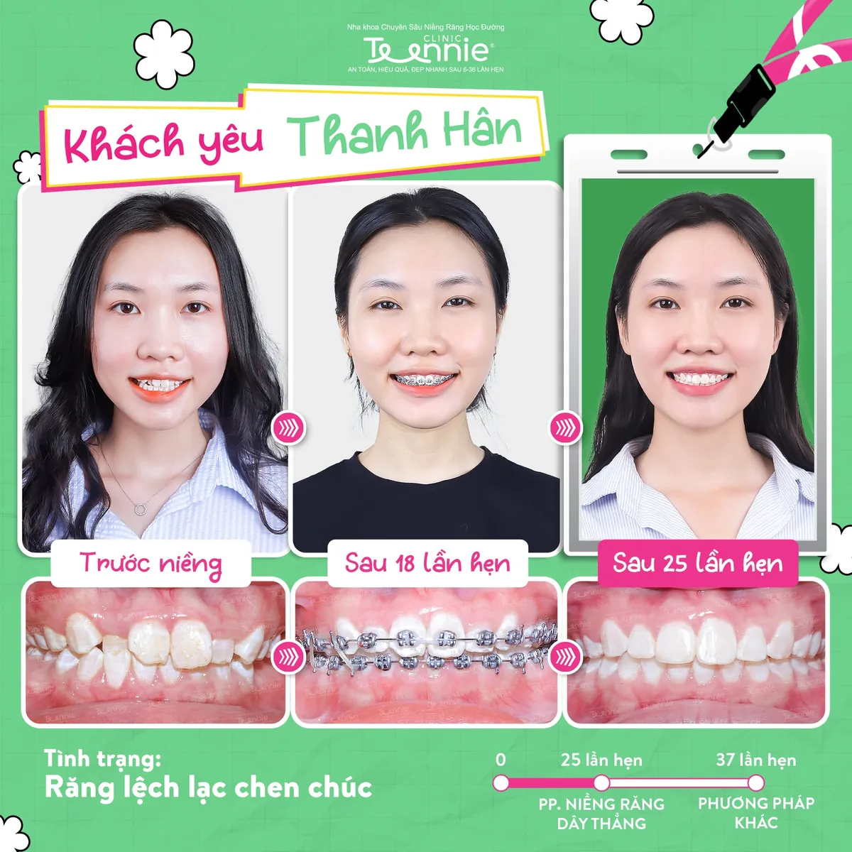 Khách hàng Thanh Hân niềng răng trước và sau tại Teennie - răng lệch lạc chen chúc, đẹp sau 25 lần hẹn