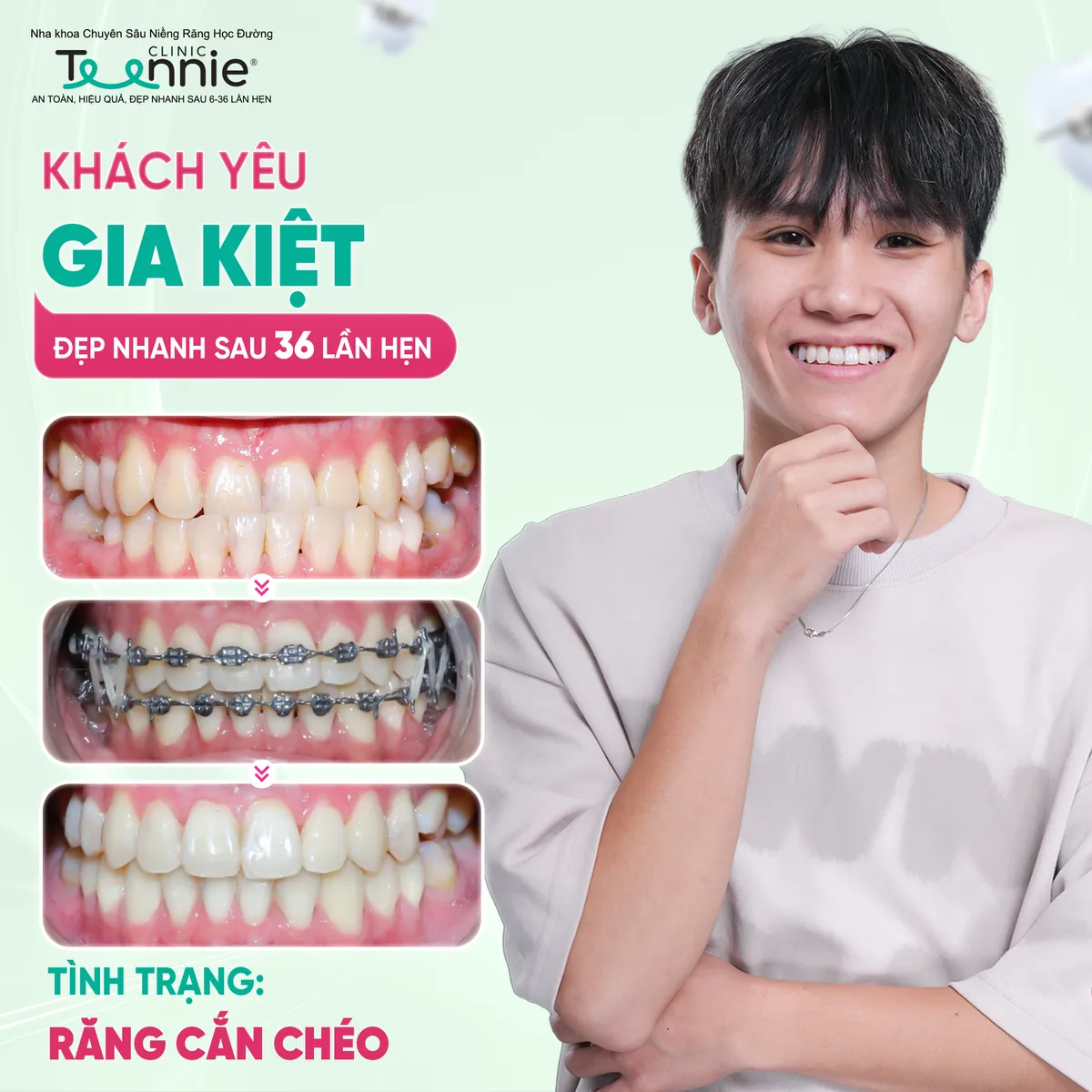 Niềng răng cắn chéo trước và sau tại Teennie - khách hàng Gia Kiệt đẹp sau 36 lần hẹn