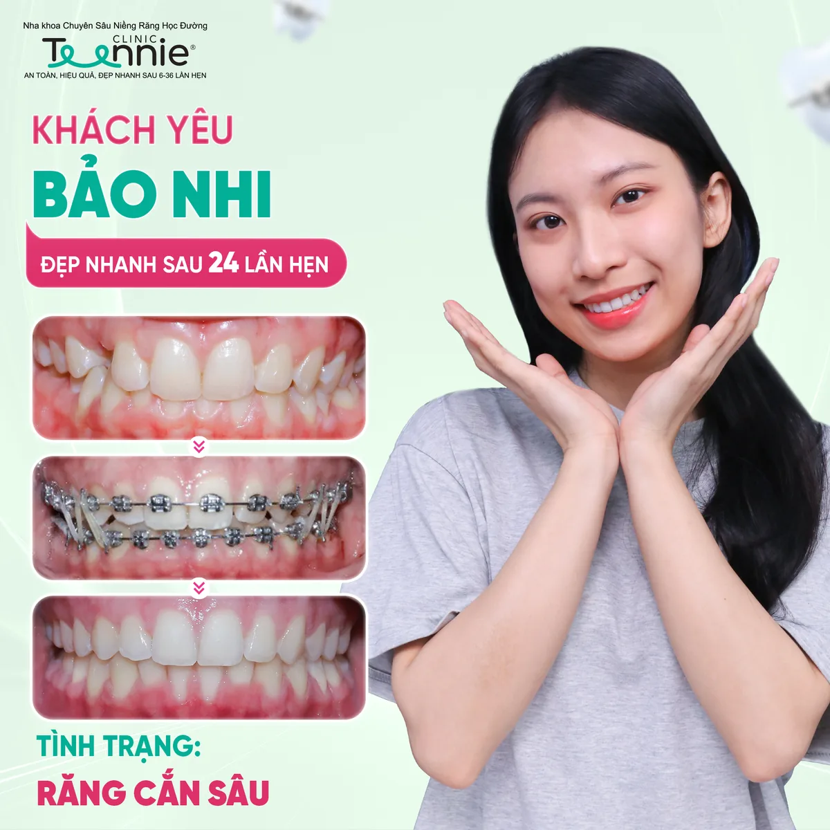 Niềng răng cắn sâu trước và sau tại Teennie - khách hàng Bảo Nhi đẹp sau 24 lần hẹn