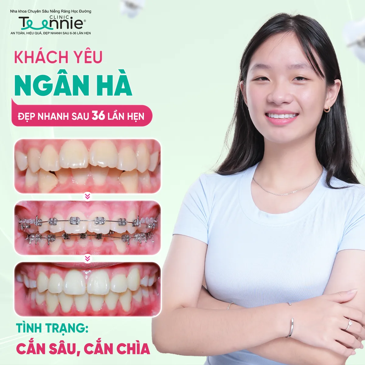 Niềng răng hô cắn chìa trước và sau tại Teennie - khách hàng Ngân Hà đẹp sau 36 lần hẹn