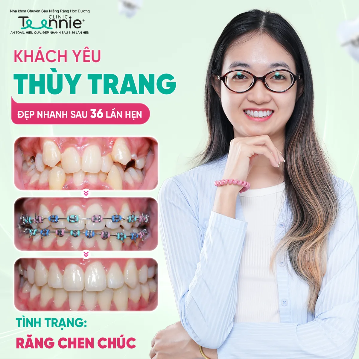 Niềng răng lệch lạc chen chúc trước và sau tại Teennie - khách hàng Thùy Trang đẹp sau 36 lần hẹn