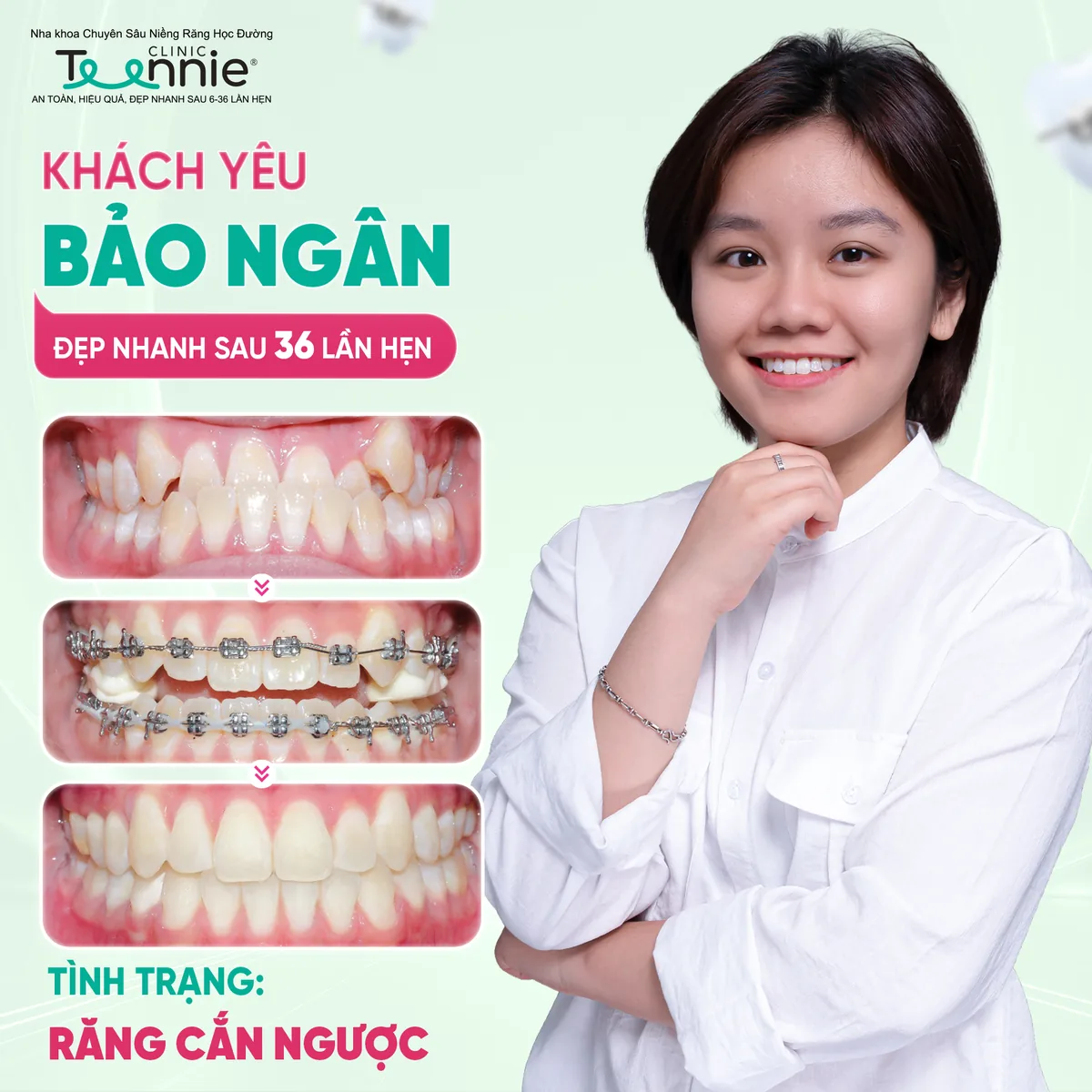 Niềng răng móm cắn ngược trước và sau tại Teennie - khách hàng Bảo Ngân đẹp sau 36 lần hẹn