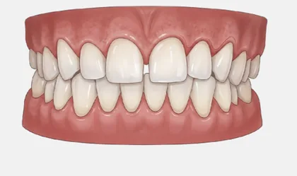 Niềng răng mức độ 1 (Nhẹ) - minh hoạ tình trạng sai lệch răng tại Teennie